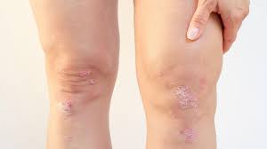 Image result for psoriasis