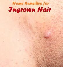 18 D I Y Ingrown Hair Ideas Ingrown Hair Ingrown Hair Remedies Ingrown Hair Removal