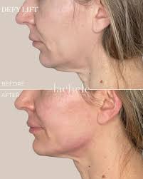 One appointment. One customized plan. Remarkable results. This incredible  transformation was achieved in a single visit using 7 expertly placed  syringes to restore balance and structure to the cheeks, piriform area,  smile