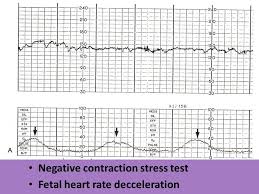 You may start to feel your baby move as early as 16 weeks pregnant. Negative Stress Test Pregnancy Pregnancywalls