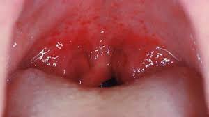 Image result for Physical injury red spots roof of mouth