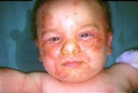 Che cosa sono le infezioni da stafilococco aureo? Scalded Skin Syndrome Da Stafilococco