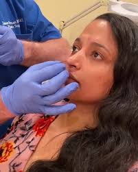 Xeomin to the depressor septi...