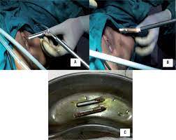 SciELO - Brazil - Unusual intravesical foreign body in young female  migrated from vagina due to autoerotism Unusual intravesical foreign body  in young female migrated from vagina due to autoerotism