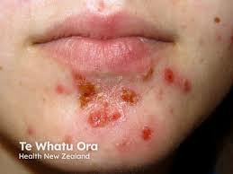 Image result for Impetigo