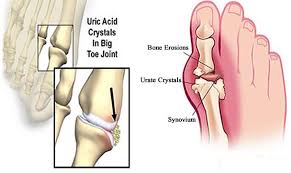 Obat Asam Urat Yang Paling Ampuh