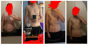 Should I Start Saving For Loose Skin Surgery Now Or Give It Time Last 2 Pics Are About 4 Months Apart And The First 1 Was Last March At