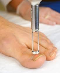 Laser Nail Fungus Treatment In North Texas Graff Foot Ankle And Wound Care