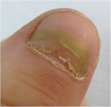 Image result for Yellow nail syndrome feet