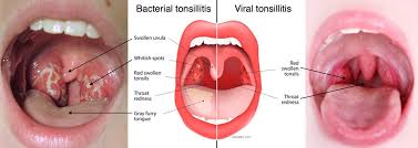 Check spelling or type a new query. Tonsillectomy And Adenoidectomy T A Fort Worth Ent Sinus