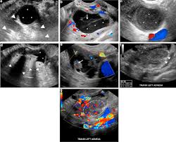 So far, no screening method. Adnexal Lesions Imaging Strategies For Ultrasound And Mr Imaging Sciencedirect