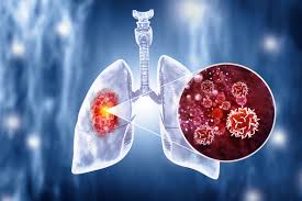 Image result for Lung Cancer