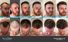 Before the vitamins i was only getting a half inch a month. Hair Transplant How Fast Does Hair Grow After With Pictures