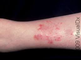 Image result for Stasis Dermatitis