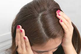 Mulai dari penyebab, hingga cara mengurangi rambut rontok dan ketombe yang paling efektif, untuk mempersingkat waktu, langsung saja kita simak pembahasannya. 3 Tips Pilih Sampo Yang Tepat Untuk Atasi Ketombe