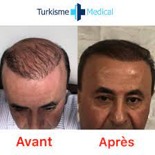 La turquie n'a rien à envier aux autres pays d'europe notamment la france, depuis plusieurs années, la greffe de cheveux nous contacter via le formulaire pour avoir de plus amples informations sur le prix d'une greffe de cheveux en turquie. Resultat A 7 Mois De La Greffe De Cheveux Fue Greffe De Cheveux Implant Capillaire Greffe