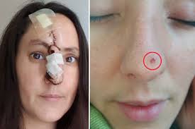 Image result for skin cancer on nose pimple