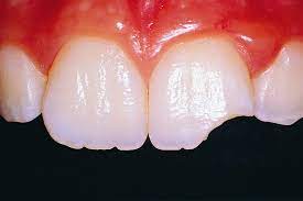 Coltre Tooth Fracture Chipped Tooth Chipped Tooth Repair Cosmetic Dentistry