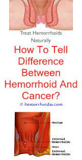 Colon cancer (also known as colorectal cancer) is a malignant tumor, arising from the inner wall of the large intestine. Pin En Health