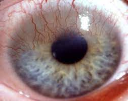 Kontaktlinsen Auge Online