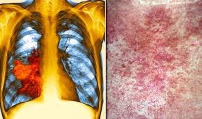 This condition can occur in one or both lungs and can affect a adenocarcinoma, large cell carcinoma, and squamous cell carcinoma are the major types. Lung Cancer Symptoms Signs Of A Tumour Include An Itchy Rash On Your Skin Express Co Uk