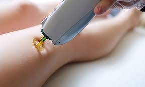 The hair follicle is damaged by the laser's heat, resulting in an inability to grow. Carmel Laser Studio Up To 93 Off Carmel In Groupon