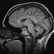 Se requieren pruebas de esa irreversibilidad. Hipertension Intracraneal Wikipedia La Enciclopedia Libre