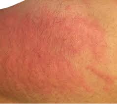 Image result for Dermatographism