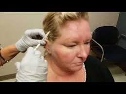 Botulinum toxins type a was certified by u.s food and drug administration as a medicine in treatment of conditions such as chronic migraine they can also be used together with botox for better results. Botox For Migraines At Mercy Youtube