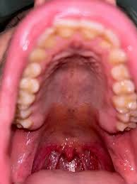 Image result for oral thrush symptoms roof of the mouth