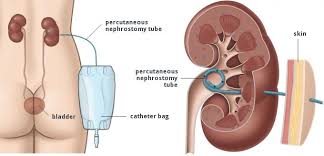 Emergency Situations In Kidney And Ureteral Stones Kidney Surgery Urinary Catheterization Nursing Mnemonics