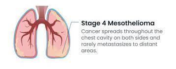 17.08.2021 · what is stage 4 mesothelioma? Mesothelioma Stages Understanding The Four Stages