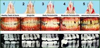 If you would like to learn how this disease affects cats, please visit this page in the petmd health library. Treating Periodontal Disease Without Surgery Miami
