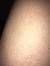 Anterolateral Leg Alopecia