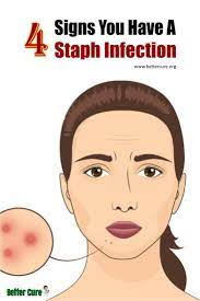 4 Signs You Have A Staph Infection Staph Infection Staph Infection Remedies Infections