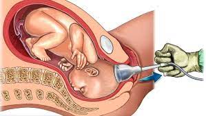 makat gelis bebegin ters durmasi nedir hamilelik com tr