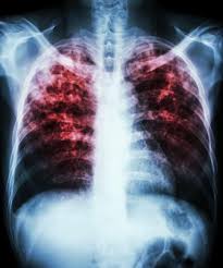 Guidance: Newer tests recommended for TB diagnosis | CIDRAP