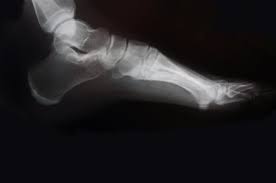 The mission of the decker student health services center is to promote and support student wellness through education, prevention and treatment in a caring atmosphere that respects the unique. Podiatry Care For Medicaid Beneficiaries Across New York State Nascentia Health Options