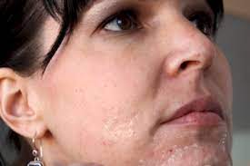 Kundenbewertungen fließen wiewohl in den maske gegen mitesser test mit ein. Mittel Gegen Mitesser Maske Aus Milch Und Gelatine Gala De