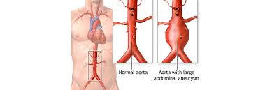 Thoracic aortic aneurysms are relatively uncommon compared to abdominal aortic aneurysms. The Danger Of Aortic Aneurysms Vascular Surgery Associates