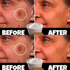 Baking soda remedy for age spots, acne, and blackheads