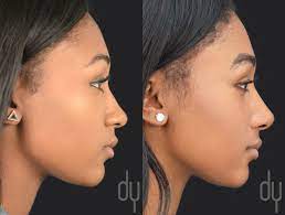 Pin On Rhinoplasty Before And After