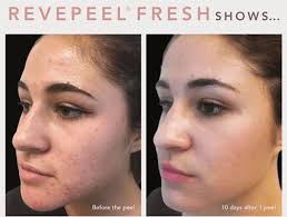 RevePeel — Le Spa