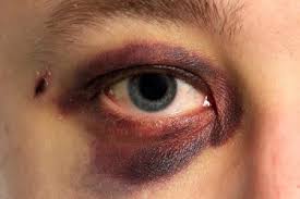 Blaues Auge Was Tun Was Hilft Und Wann Sie Zum Arzt Sollten