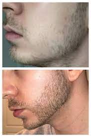 Minoxidil before and after beard result. Minoxidil Guide For Thicker Beard Facial Hair And Fuller Eyebrows