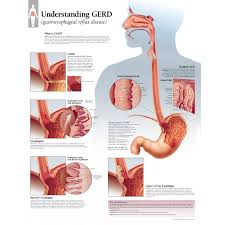 Understanding Gerd Gastroesophageal Reflux Disease Chart