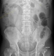 Image result for Adynamic Ileus