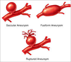 However, as an aneurysm grows larger, it can put pressure on surrounding tissues and nerves, causing neurologic. Brain Aneurysms Memphis Vascular Doctors