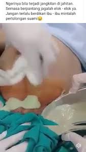 Gonore adalah salah satu penyakit menular seksual lebih mudah untuk mencegah karena bakteri yang menyebabkan. Jangkitan Kuman Luka Caesar Bengkak Bernanah Bila Tekan Keluar Macam Cheese Pa Ma