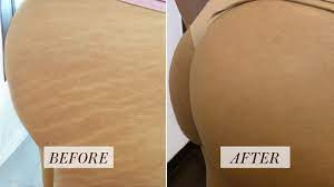 Tattoo Artist Hides Stretch Marks With Skin Colored Ink Before And After Photos Allure